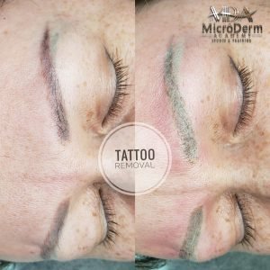 Inna Abdiyeva- Academy-S - Tattoo removal