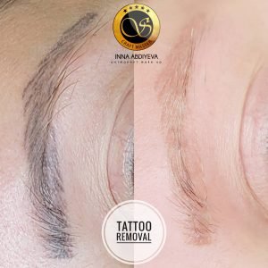 Inna Abdiyeva- Academy-S - Tattoo removal