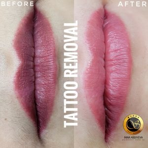 Inna Abdiyeva- Academy-S - Lips Tattoo removal