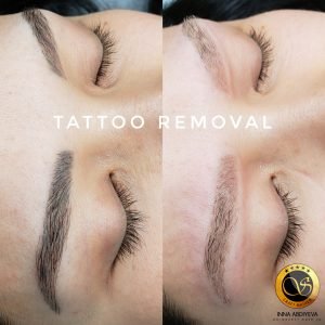 Inna Abdiyeva- Academy-S - Tattoo removal