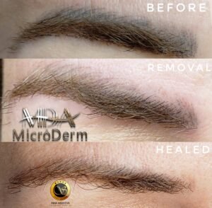 Inna Abdiyeva- Academy-S - Tattoo removal