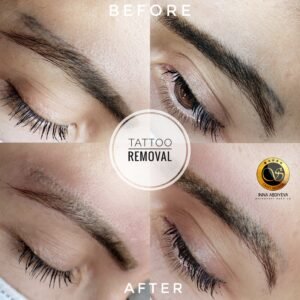 Inna Abdiyeva- Academy-S - Tattoo removal