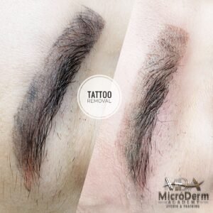 Inna Abdiyeva- Academy-S - Tattoo removal