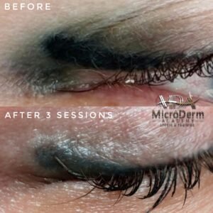 Inna Abdiyeva- Academy-S - Student's 1st works Inna Abdiyeva- Academy-S - Tattoo removal