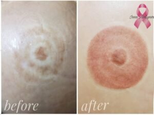 Inna Abdiyeva- Academy-S - Areola reconstruction
