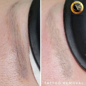 Inna Abdiyeva- Academy-S - Tattoo removal