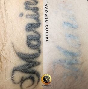 Inna Abdiyeva- Academy-S - Tattoo removal