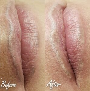 Inna Abdiyeva- Academy-S - Lips Tattoo removal