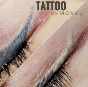 Inna Abdiyeva- Academy-S - Student's 1st works Inna Abdiyeva- Academy-S - Tattoo removal