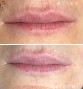 Inna Abdiyeva- Academy-S - Lips Tattoo removal