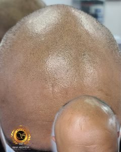 Scalp Micropigmentation for men